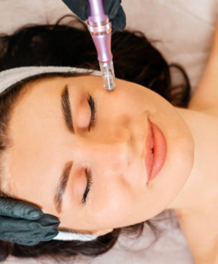 Microneedling Lyon Esthetic Clinic